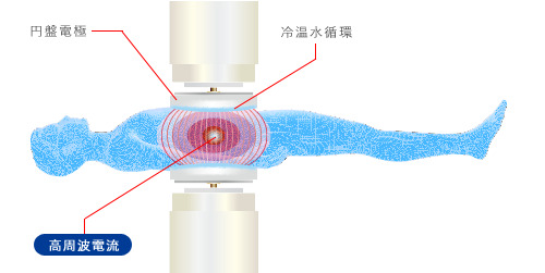 高周波式ハイパーサーミアシステムアスクーフ8